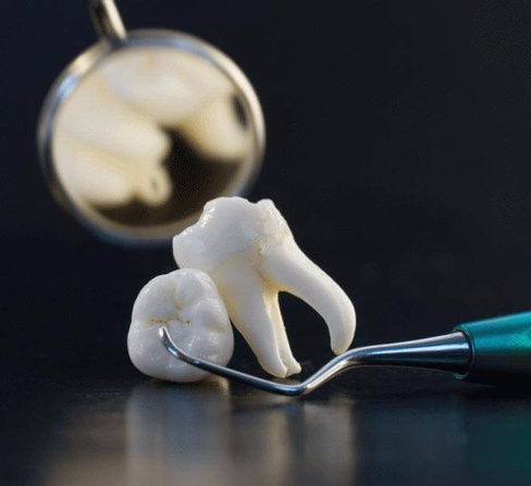 Цистэктомия + резекция верхушки корня 1го зуба (последующий зуб)