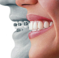 Изготовление ортодонтической аппаратуры на одну челюсть